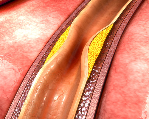 Atherectomy/Peripheral Artery Disease